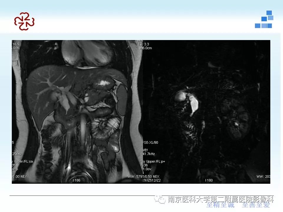 影像PPT - 【PPT】成人环状胰腺-19