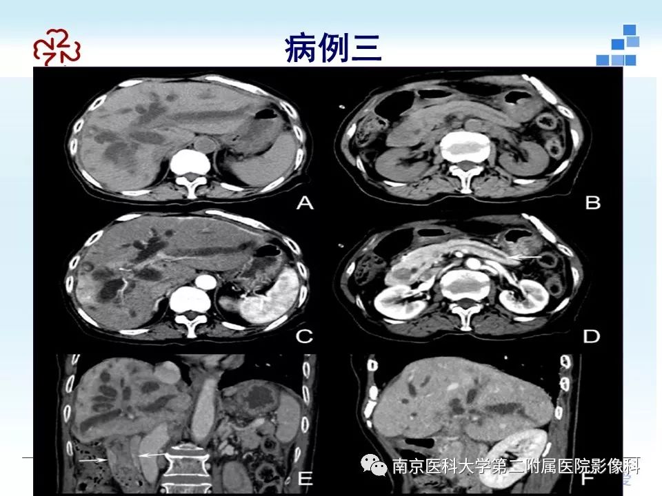影像PPT - 【PPT】成人环状胰腺-20