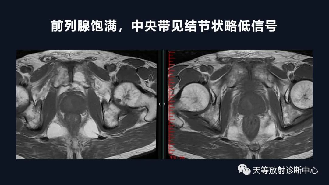 影像PPT - 深度学习:前列腺增生与前列腺癌-3 影像PPT - 深度学习:前列腺增生与前列腺癌-3