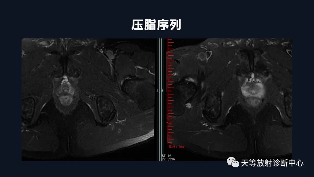 影像PPT - 深度学习:前列腺增生与前列腺癌-5 影像PPT - 深度学习:前列腺增生与前列腺癌-5