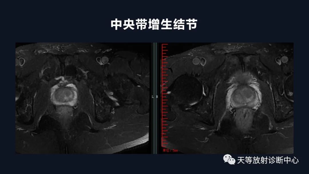 影像PPT - 深度学习:前列腺增生与前列腺癌-9 影像PPT - 深度学习:前列腺增生与前列腺癌-9