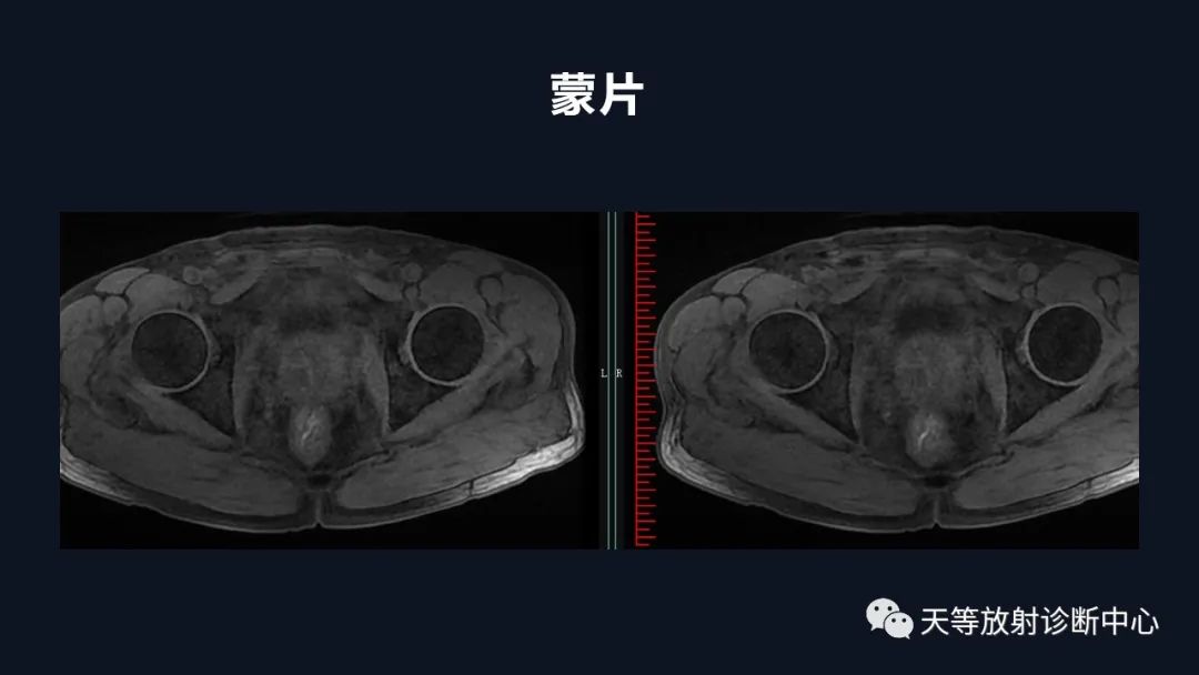 影像PPT - 深度学习:前列腺增生与前列腺癌-14 影像PPT - 深度学习:前列腺增生与前列腺癌-14