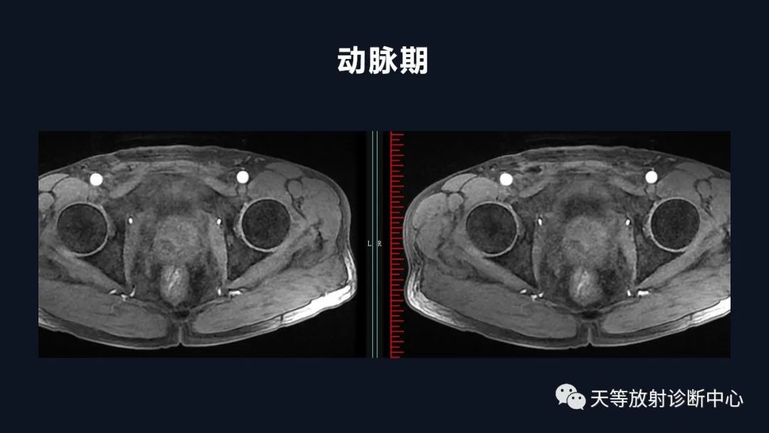 影像PPT - 深度学习:前列腺增生与前列腺癌-15 影像PPT - 深度学习:前列腺增生与前列腺癌-15