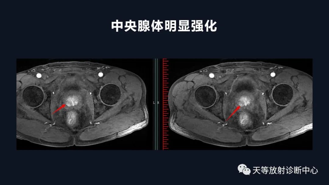 影像PPT - 深度学习:前列腺增生与前列腺癌-16 影像PPT - 深度学习:前列腺增生与前列腺癌-16