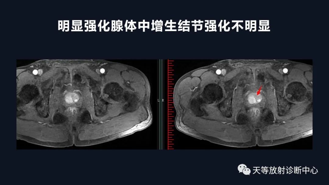 影像PPT - 深度学习:前列腺增生与前列腺癌-17 影像PPT - 深度学习:前列腺增生与前列腺癌-17