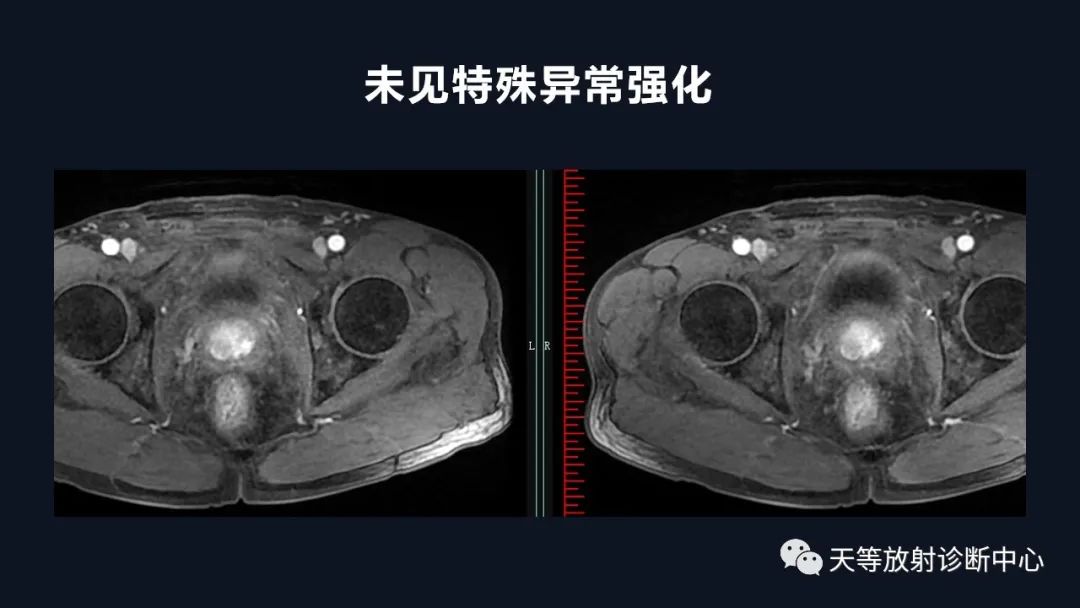 影像PPT - 深度学习:前列腺增生与前列腺癌-19 影像PPT - 深度学习:前列腺增生与前列腺癌-19