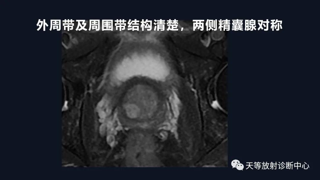 影像PPT - 深度学习:前列腺增生与前列腺癌-21 影像PPT - 深度学习:前列腺增生与前列腺癌-21