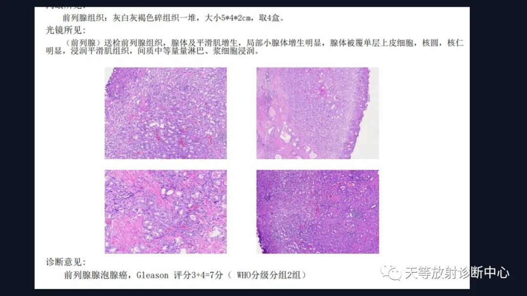 影像PPT - 深度学习:前列腺增生与前列腺癌-23 影像PPT - 深度学习:前列腺增生与前列腺癌-23