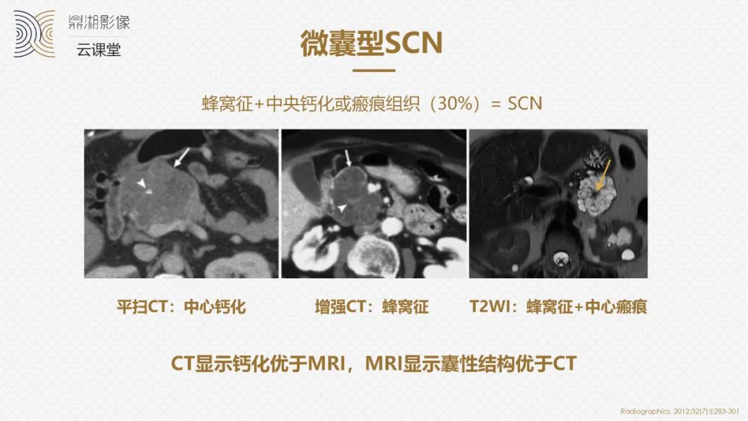 影像PPT - “囊外囊”征象可以特异性诊断“胰腺寡囊型浆液性囊腺瘤”(SCN)-2 影像PPT - “囊外囊”征象可以特异性诊断“胰腺寡囊型浆液性囊腺瘤”(SCN)-2