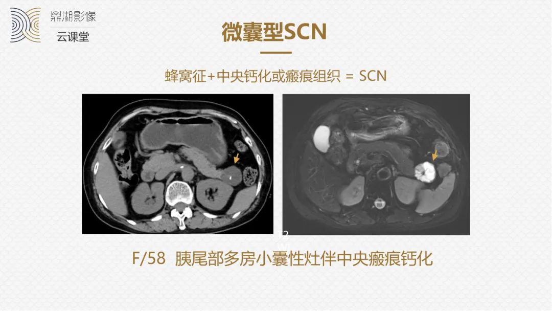 影像PPT - “囊外囊”征象可以特异性诊断“胰腺寡囊型浆液性囊腺瘤”(SCN)-3 影像PPT - “囊外囊”征象可以特异性诊断“胰腺寡囊型浆液性囊腺瘤”(SCN)-3