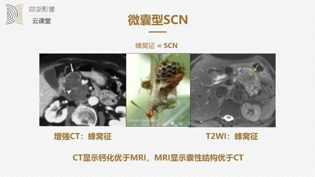 影像PPT - “囊外囊”征象可以特异性诊断“胰腺寡囊型浆液性囊腺瘤”(SCN)-4 影像PPT - “囊外囊”征象可以特异性诊断“胰腺寡囊型浆液性囊腺瘤”(SCN)-4
