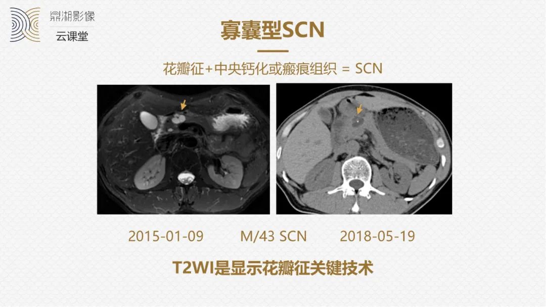 影像PPT - “囊外囊”征象可以特异性诊断“胰腺寡囊型浆液性囊腺瘤”(SCN)-6 影像PPT - “囊外囊”征象可以特异性诊断“胰腺寡囊型浆液性囊腺瘤”(SCN)-6