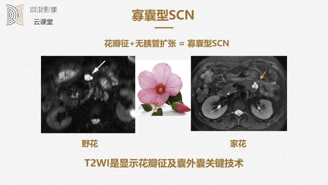 影像PPT - “囊外囊”征象可以特异性诊断“胰腺寡囊型浆液性囊腺瘤”(SCN)-7 影像PPT - “囊外囊”征象可以特异性诊断“胰腺寡囊型浆液性囊腺瘤”(SCN)-7