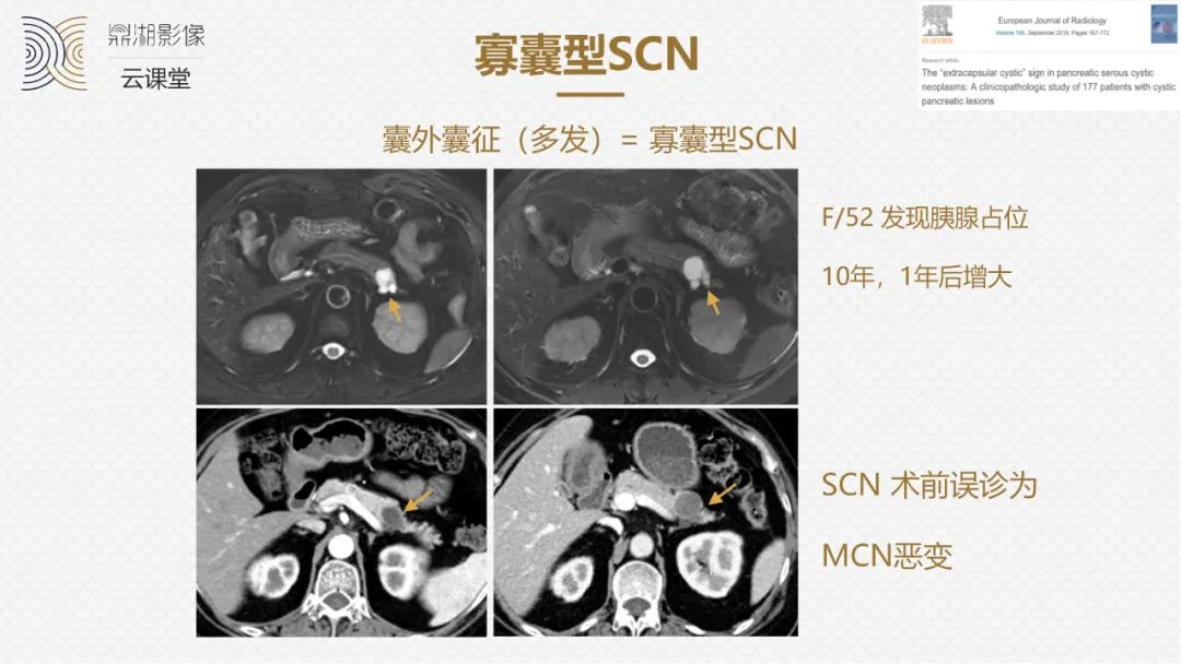 影像PPT - “囊外囊”征象可以特异性诊断“胰腺寡囊型浆液性囊腺瘤”(SCN)-8 影像PPT - “囊外囊”征象可以特异性诊断“胰腺寡囊型浆液性囊腺瘤”(SCN)-8