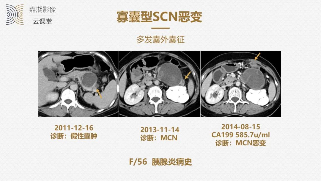 影像PPT - “囊外囊”征象可以特异性诊断“胰腺寡囊型浆液性囊腺瘤”(SCN)-9 影像PPT - “囊外囊”征象可以特异性诊断“胰腺寡囊型浆液性囊腺瘤”(SCN)-9