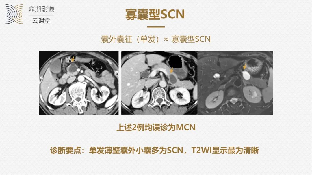 影像PPT - “囊外囊”征象可以特异性诊断“胰腺寡囊型浆液性囊腺瘤”(SCN)-10 影像PPT - “囊外囊”征象可以特异性诊断“胰腺寡囊型浆液性囊腺瘤”(SCN)-10
