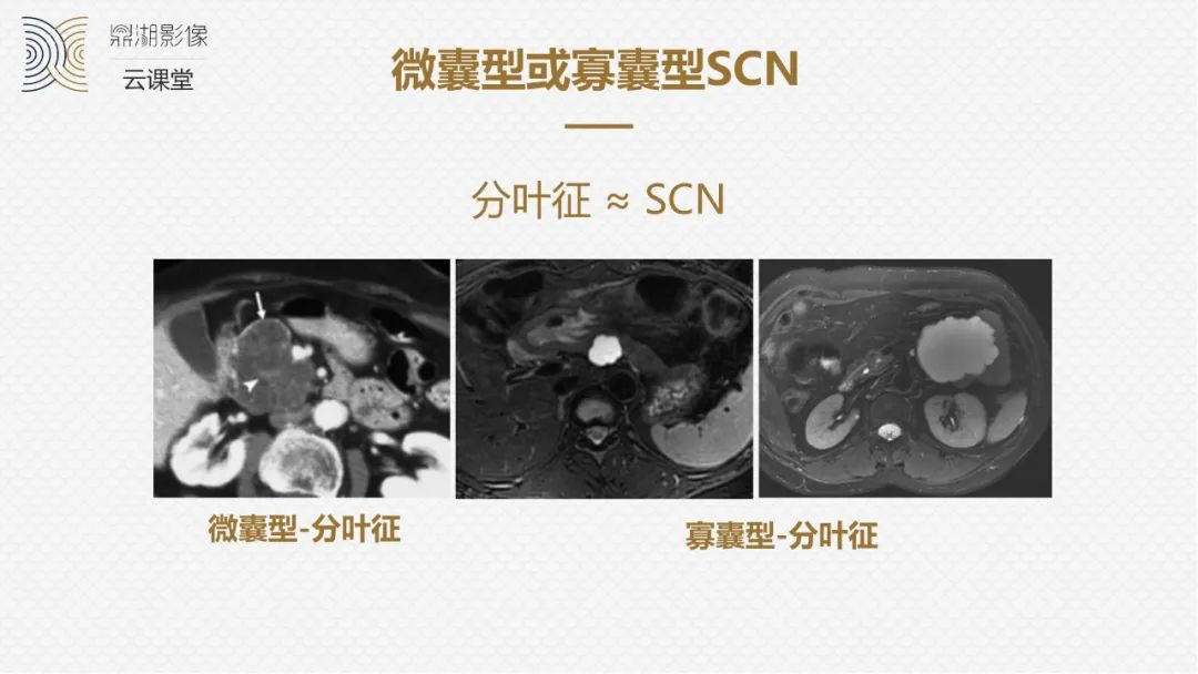 影像PPT - “囊外囊”征象可以特异性诊断“胰腺寡囊型浆液性囊腺瘤”(SCN)-11 影像PPT - “囊外囊”征象可以特异性诊断“胰腺寡囊型浆液性囊腺瘤”(SCN)-11