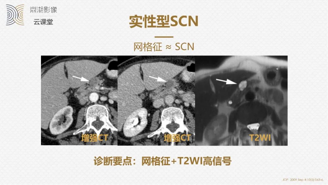 影像PPT - “囊外囊”征象可以特异性诊断“胰腺寡囊型浆液性囊腺瘤”(SCN)-13 影像PPT - “囊外囊”征象可以特异性诊断“胰腺寡囊型浆液性囊腺瘤”(SCN)-13