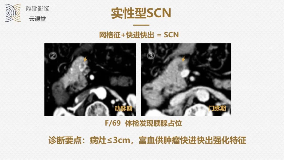 影像PPT - “囊外囊”征象可以特异性诊断“胰腺寡囊型浆液性囊腺瘤”(SCN)-14 影像PPT - “囊外囊”征象可以特异性诊断“胰腺寡囊型浆液性囊腺瘤”(SCN)-14
