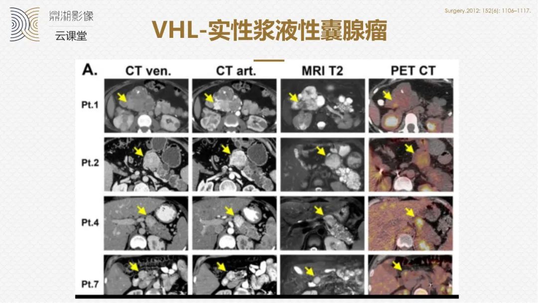 影像PPT - “囊外囊”征象可以特异性诊断“胰腺寡囊型浆液性囊腺瘤”(SCN)-18 影像PPT - “囊外囊”征象可以特异性诊断“胰腺寡囊型浆液性囊腺瘤”(SCN)-18