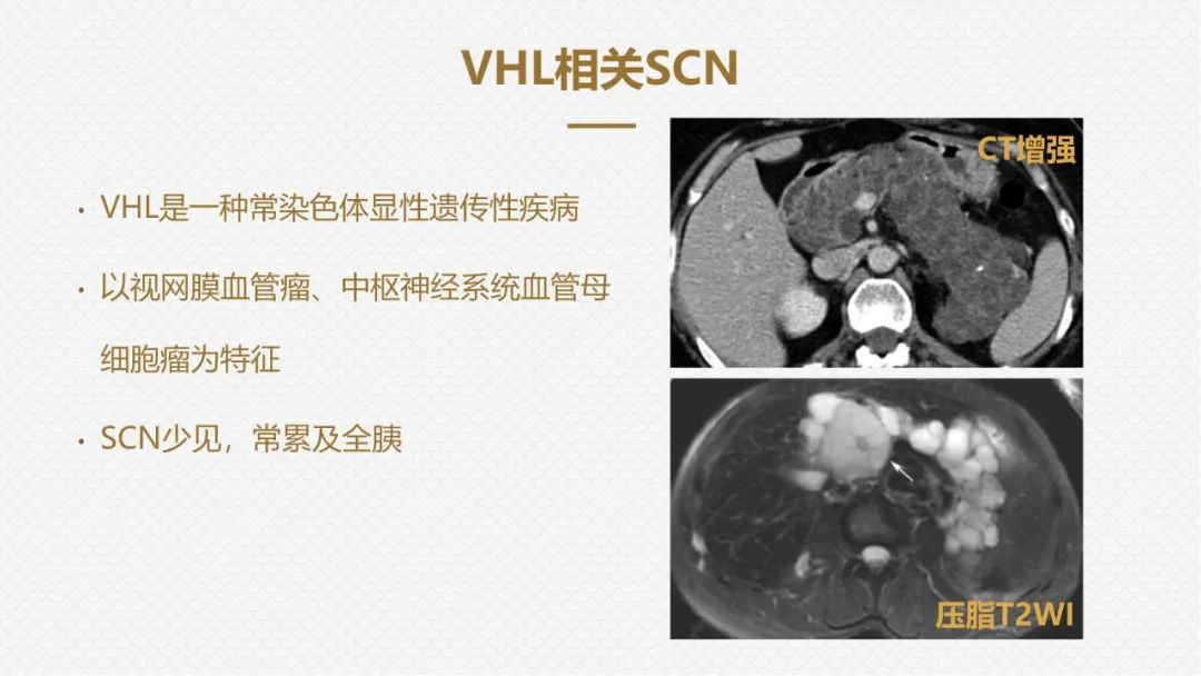 影像PPT - “囊外囊”征象可以特异性诊断“胰腺寡囊型浆液性囊腺瘤”(SCN)-16 影像PPT - “囊外囊”征象可以特异性诊断“胰腺寡囊型浆液性囊腺瘤”(SCN)-16