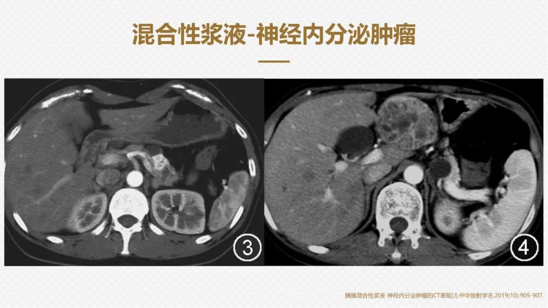 影像PPT - “囊外囊”征象可以特异性诊断“胰腺寡囊型浆液性囊腺瘤”(SCN)-19 影像PPT - “囊外囊”征象可以特异性诊断“胰腺寡囊型浆液性囊腺瘤”(SCN)-19