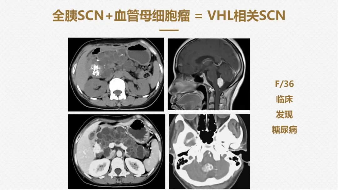 影像PPT - “囊外囊”征象可以特异性诊断“胰腺寡囊型浆液性囊腺瘤”(SCN)-17 影像PPT - “囊外囊”征象可以特异性诊断“胰腺寡囊型浆液性囊腺瘤”(SCN)-17
