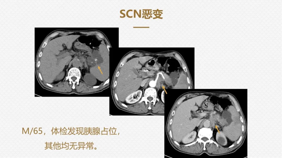 影像PPT - “囊外囊”征象可以特异性诊断“胰腺寡囊型浆液性囊腺瘤”(SCN)-23 影像PPT - “囊外囊”征象可以特异性诊断“胰腺寡囊型浆液性囊腺瘤”(SCN)-23
