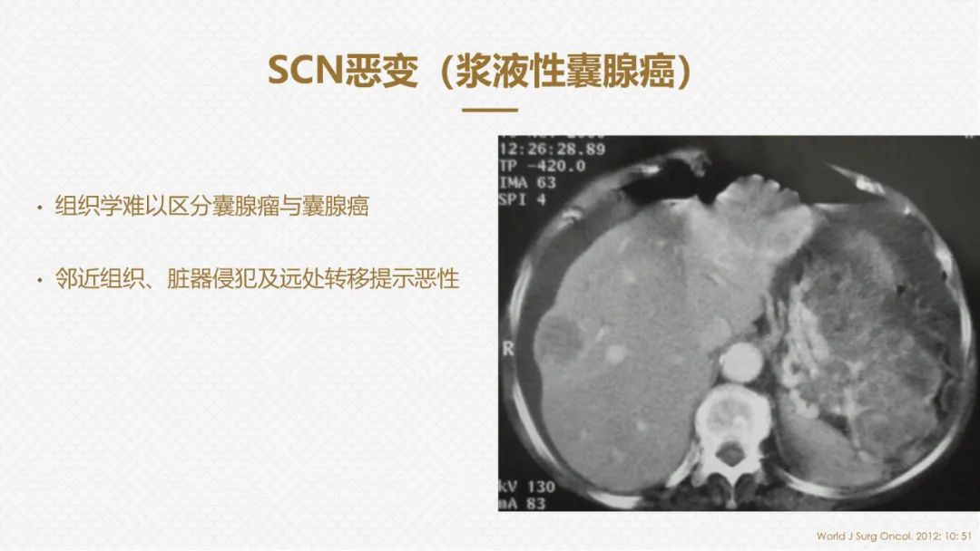 影像PPT - “囊外囊”征象可以特异性诊断“胰腺寡囊型浆液性囊腺瘤”(SCN)-22 影像PPT - “囊外囊”征象可以特异性诊断“胰腺寡囊型浆液性囊腺瘤”(SCN)-22