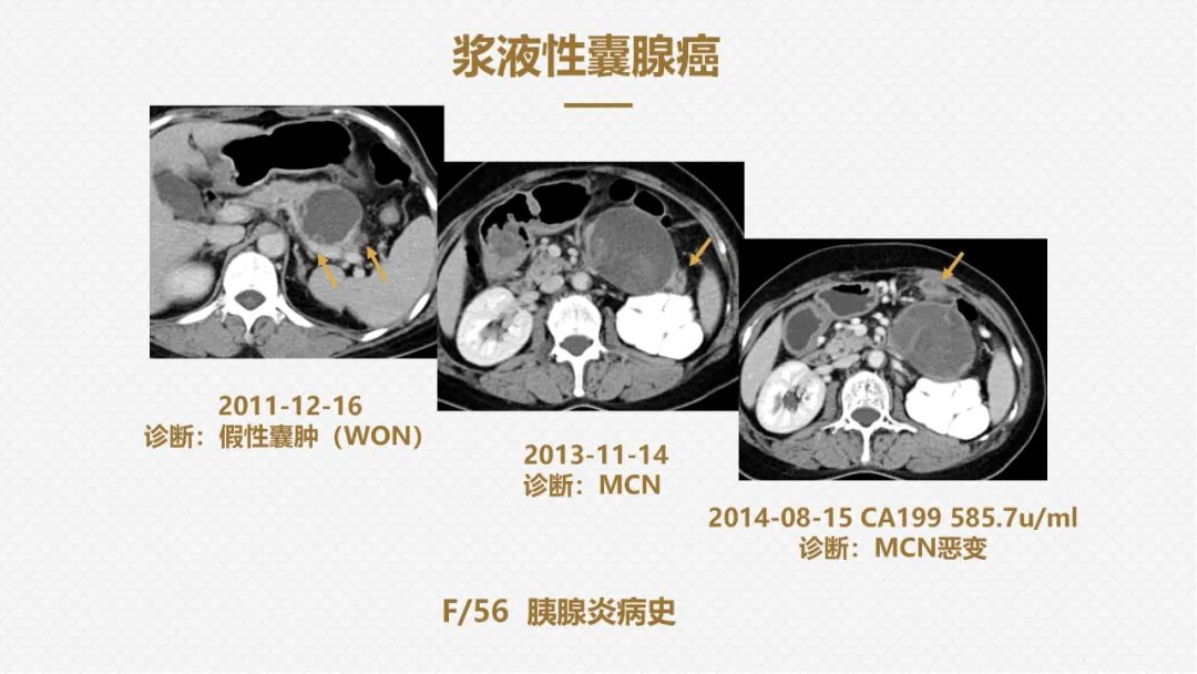 影像PPT - “囊外囊”征象可以特异性诊断“胰腺寡囊型浆液性囊腺瘤”(SCN)-24 影像PPT - “囊外囊”征象可以特异性诊断“胰腺寡囊型浆液性囊腺瘤”(SCN)-24