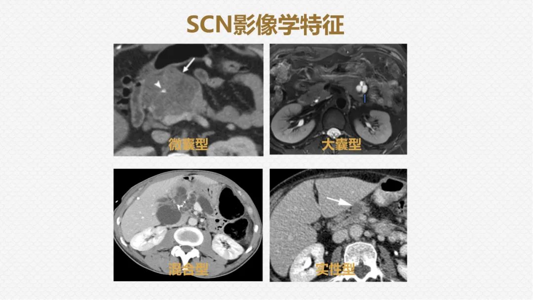 影像PPT - “囊外囊”征象可以特异性诊断“胰腺寡囊型浆液性囊腺瘤”(SCN)-21 影像PPT - “囊外囊”征象可以特异性诊断“胰腺寡囊型浆液性囊腺瘤”(SCN)-21