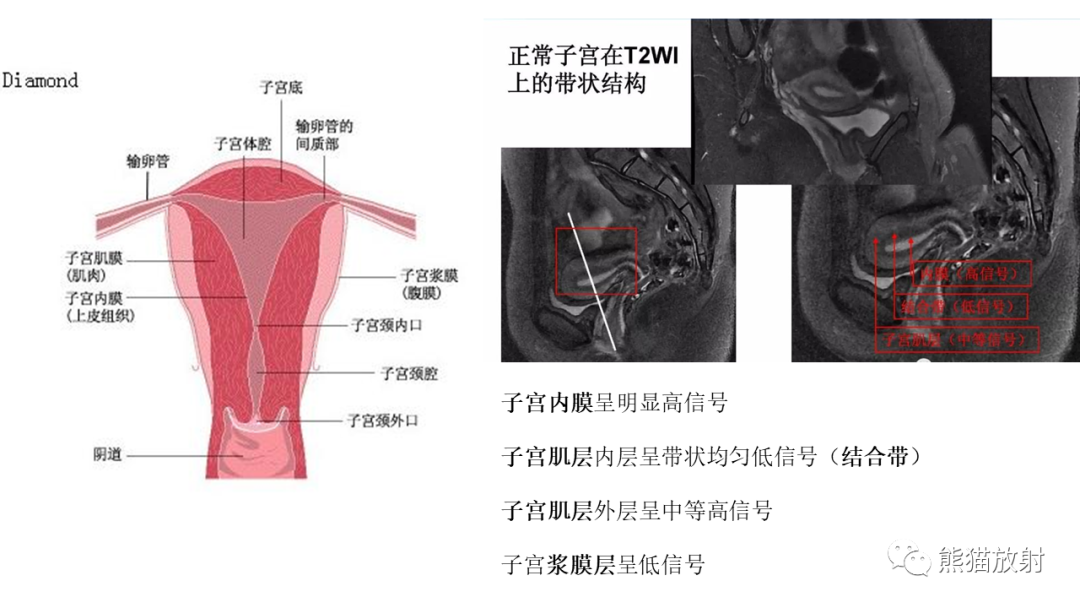 影像PPT - 【病例】子宫内膜息肉样增生 VS 子宫内膜癌 MR-26