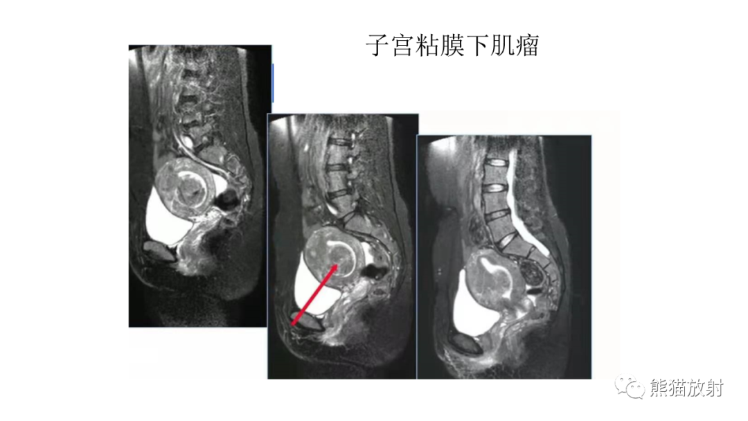 影像PPT - 【病例】子宫内膜息肉样增生 VS 子宫内膜癌 MR-47