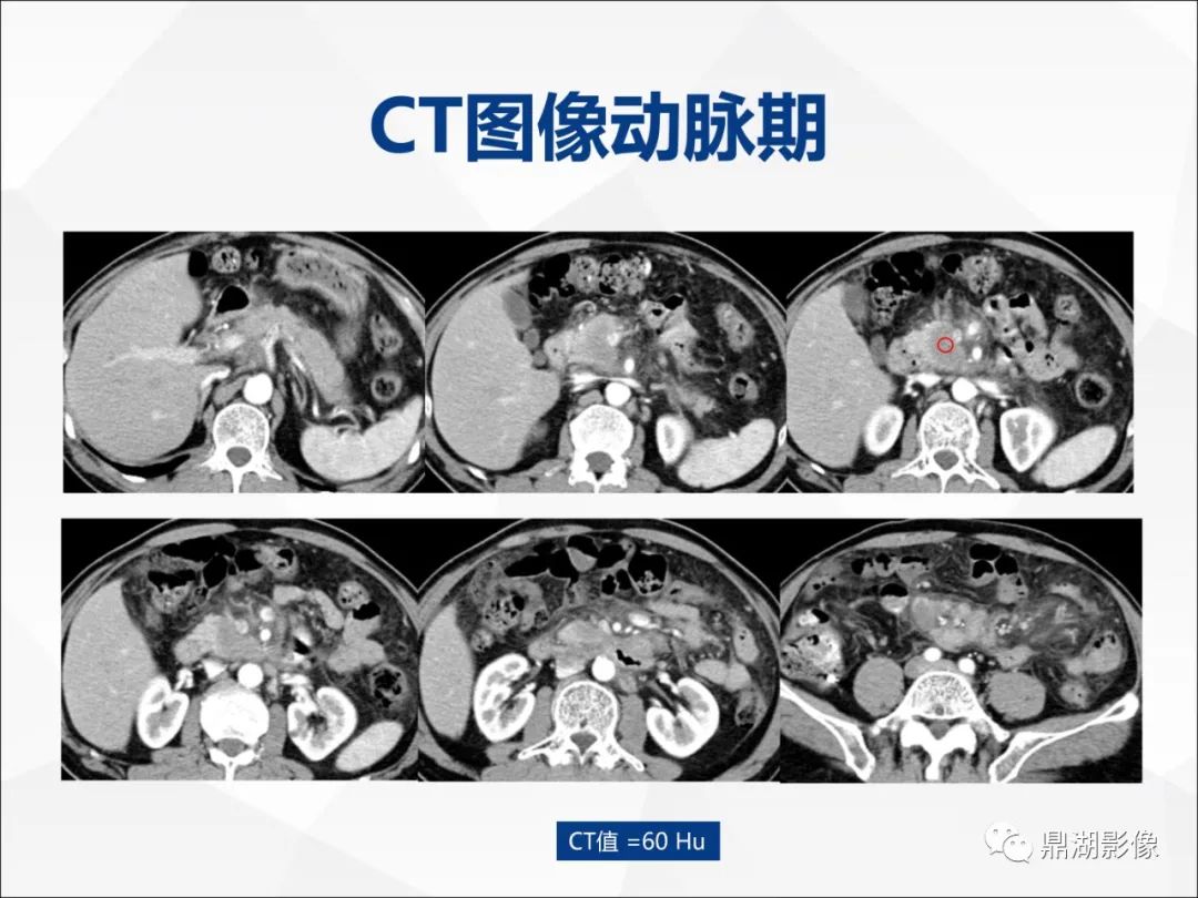 影像PPT - 【PPT】胰腺淋巴瘤1例CT及MR-4