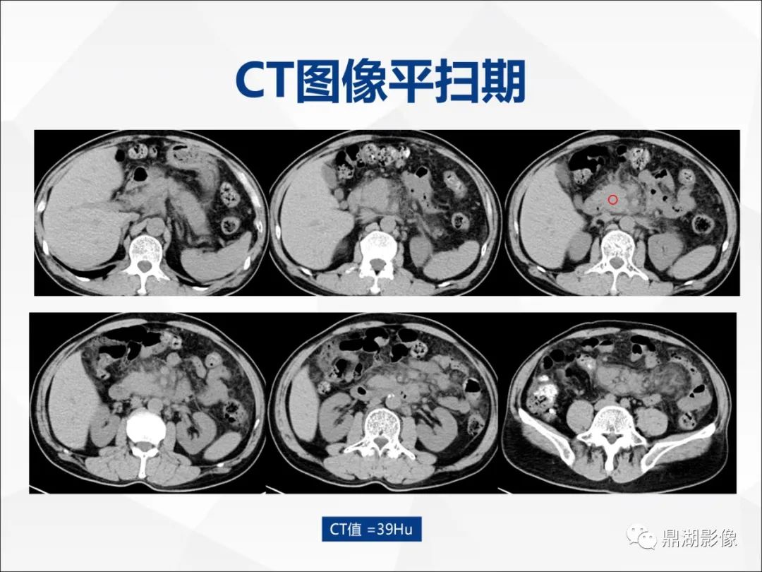 影像PPT - 【PPT】胰腺淋巴瘤1例CT及MR-3