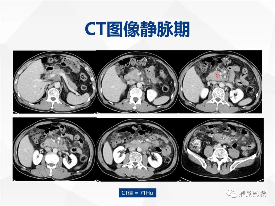 影像PPT - 【PPT】胰腺淋巴瘤1例CT及MR-5