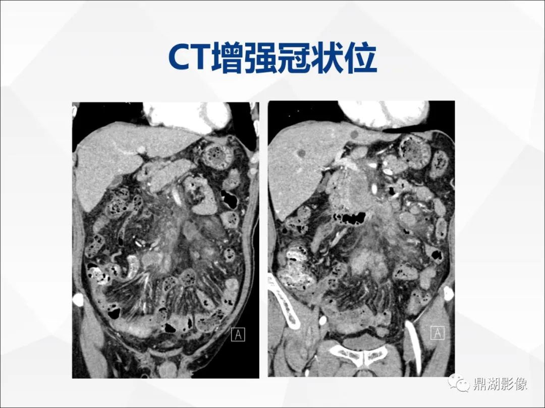 影像PPT - 【PPT】胰腺淋巴瘤1例CT及MR-6