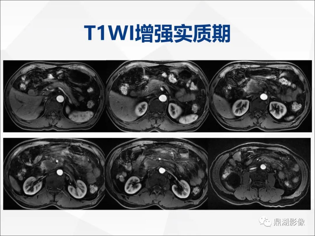 影像PPT - 【PPT】胰腺淋巴瘤1例CT及MR-12