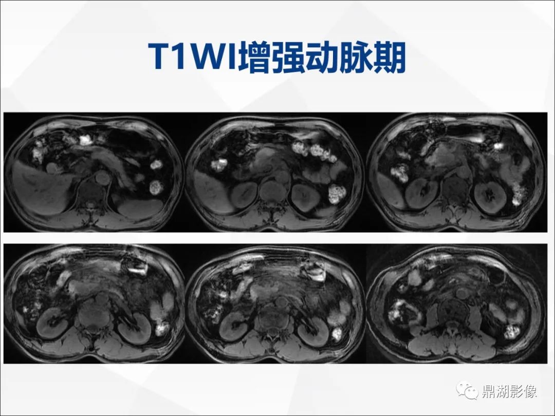 影像PPT - 【PPT】胰腺淋巴瘤1例CT及MR-11
