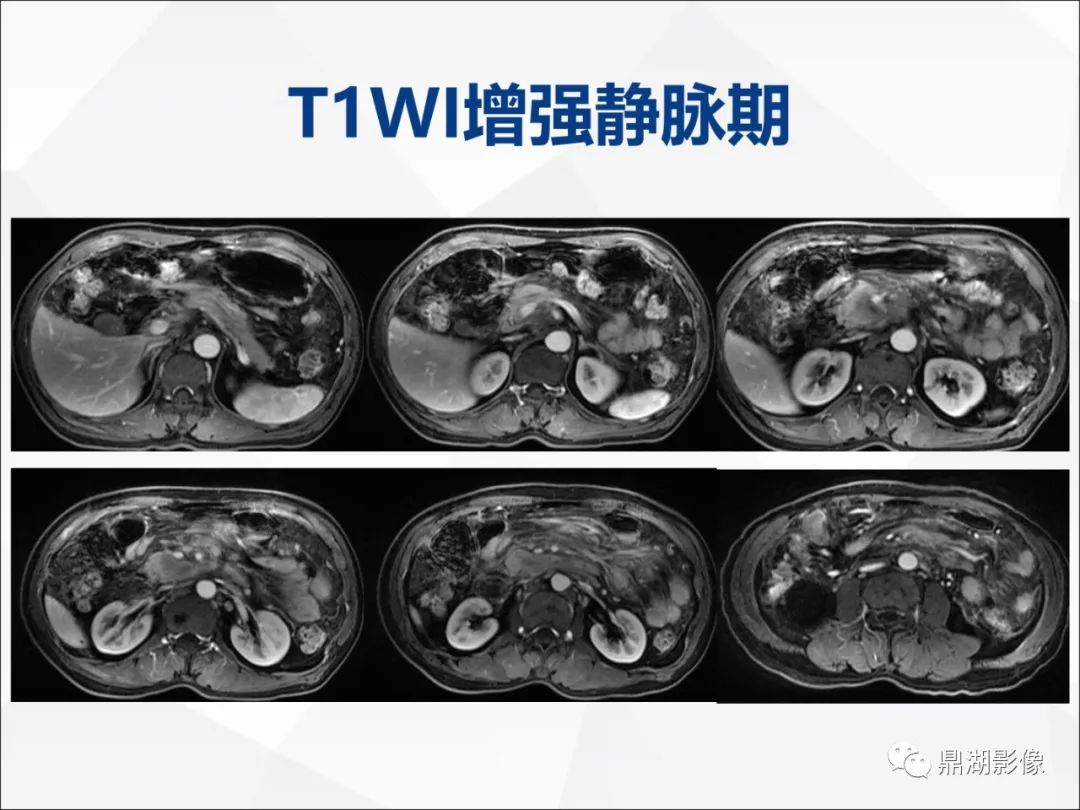 影像PPT - 【PPT】胰腺淋巴瘤1例CT及MR-13