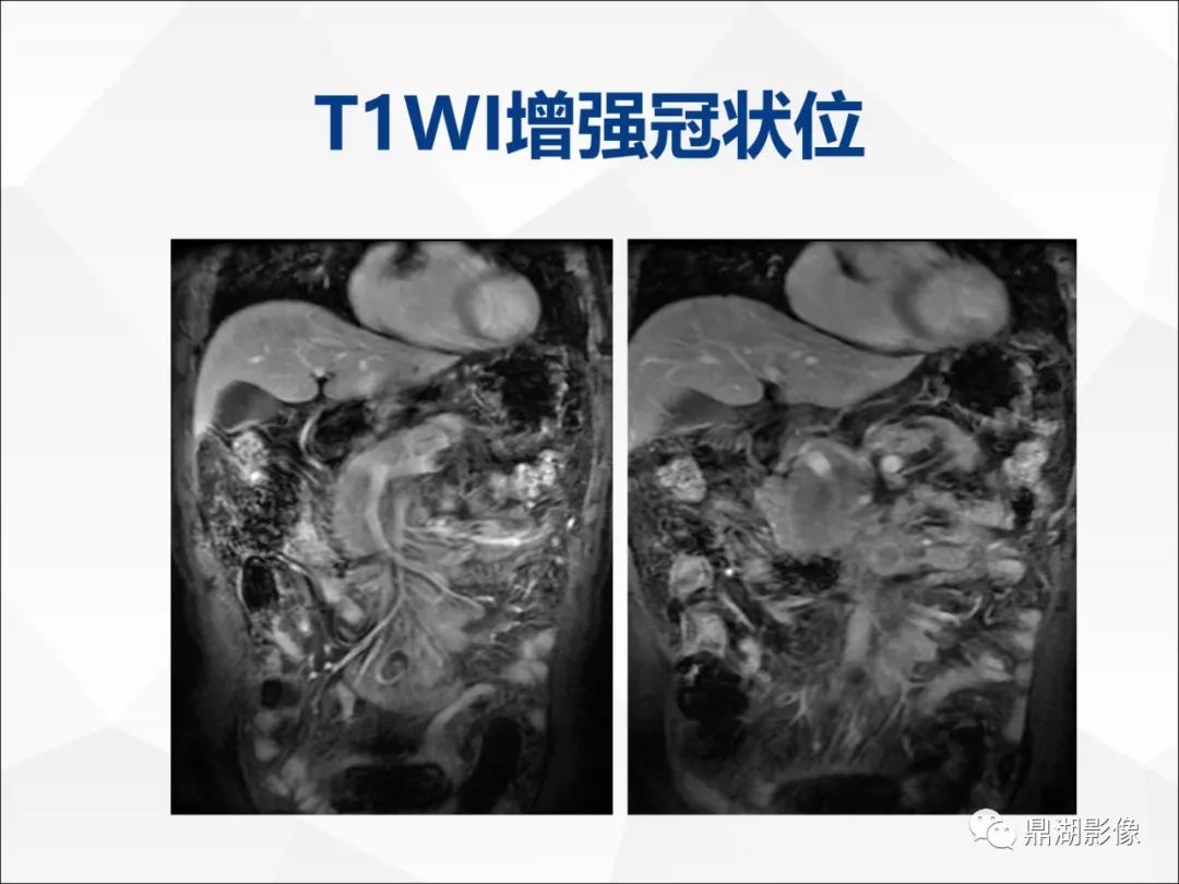 影像PPT - 【PPT】胰腺淋巴瘤1例CT及MR-15