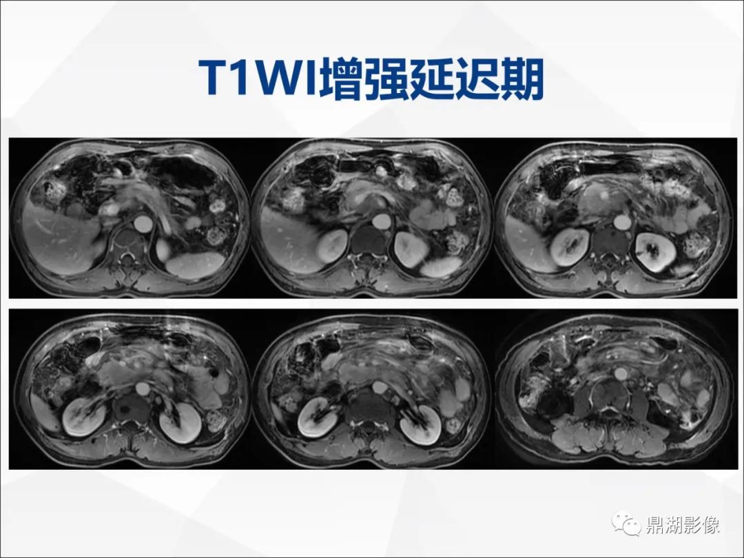 影像PPT - 【PPT】胰腺淋巴瘤1例CT及MR-14