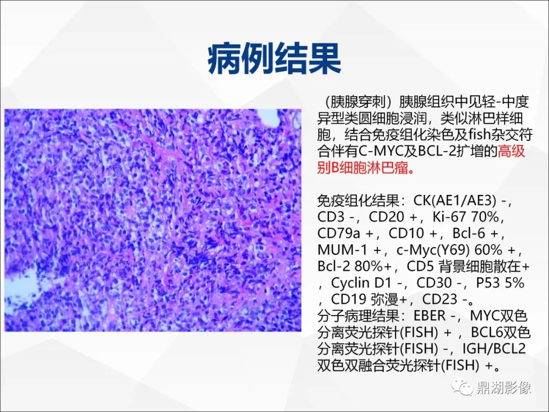 影像PPT - 【PPT】胰腺淋巴瘤1例CT及MR-17