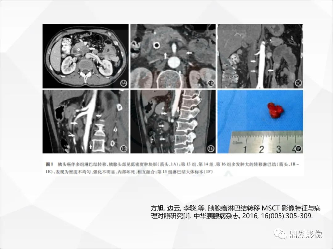 影像PPT - 【PPT】胰腺淋巴瘤1例CT及MR-24