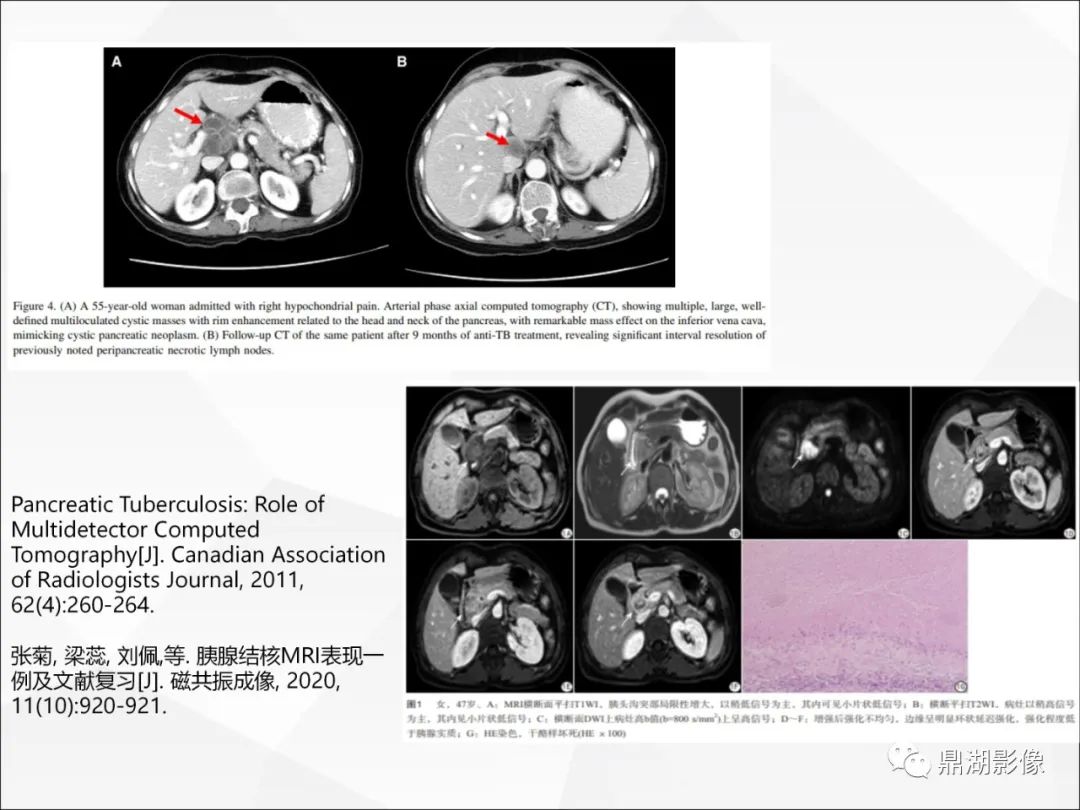 影像PPT - 【PPT】胰腺淋巴瘤1例CT及MR-26