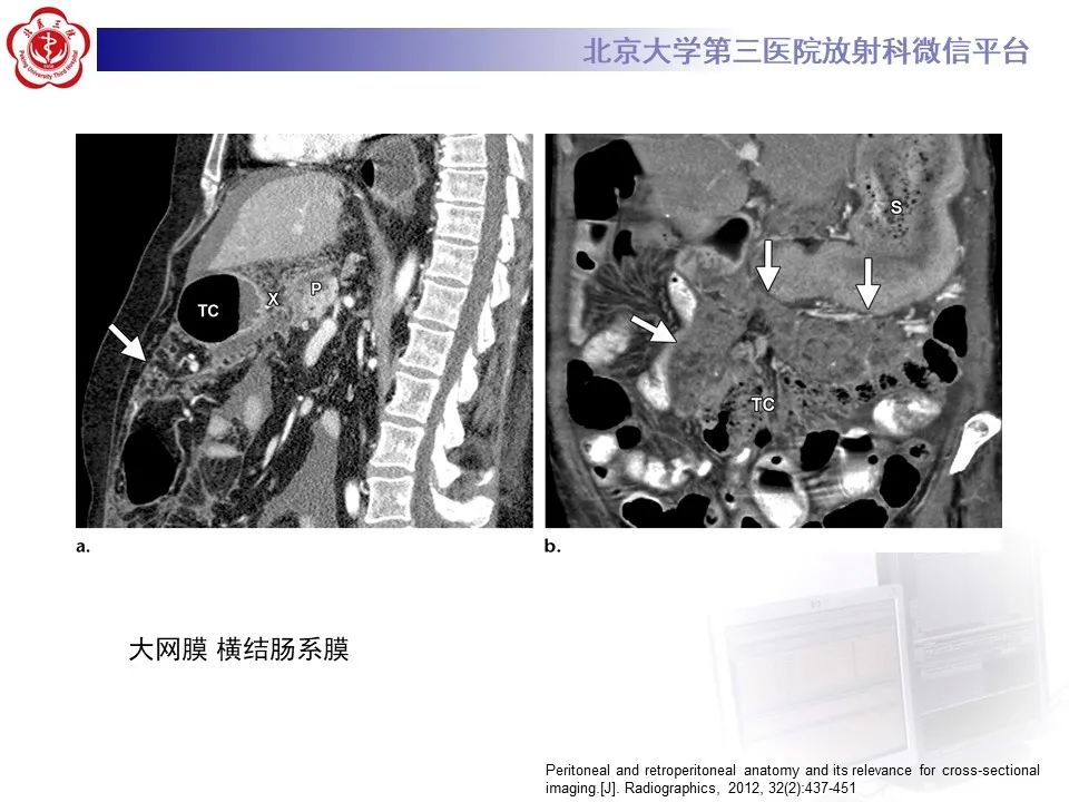 影像PPT - 【PPT】腹膜及腹膜后解剖及影像-11
