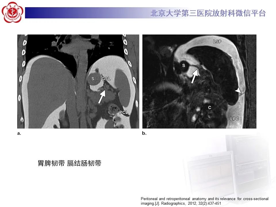 影像PPT - 【PPT】腹膜及腹膜后解剖及影像-10