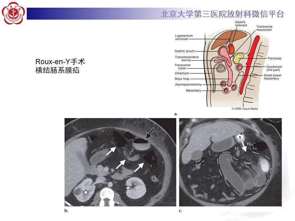 影像PPT - 【PPT】腹膜及腹膜后解剖及影像-15