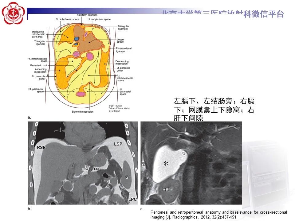 影像PPT - 【PPT】腹膜及腹膜后解剖及影像-21
