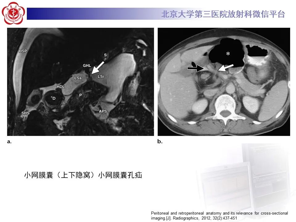 影像PPT - 【PPT】腹膜及腹膜后解剖及影像-22